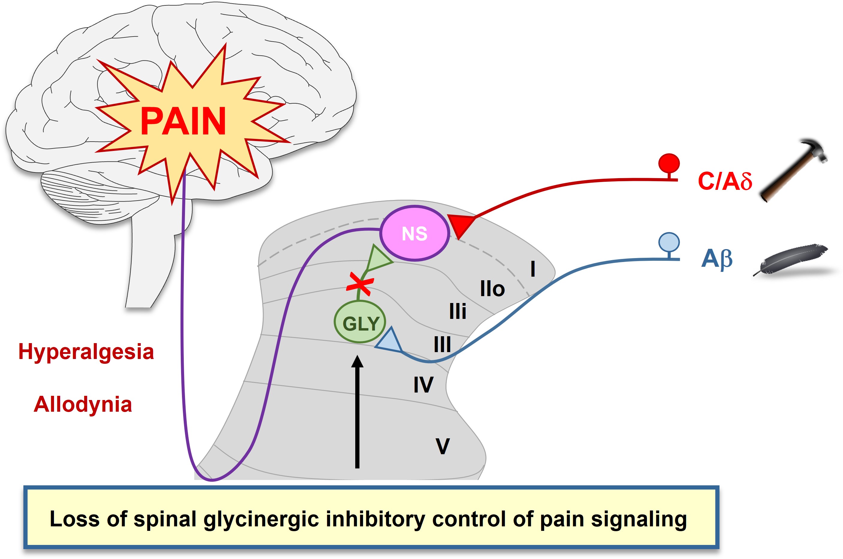 Dysinhibition of Spinal Glycinergic Signaling